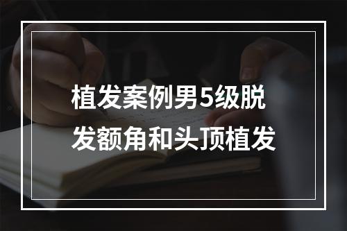 植发案例男5级脱发额角和头顶植发