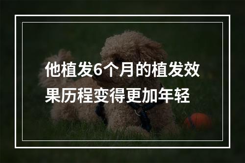 他植发6个月的植发效果历程变得更加年轻