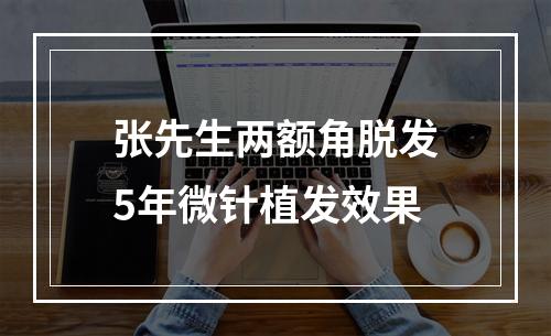 张先生两额角脱发5年微针植发效果