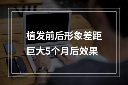 植发前后形象差距巨大5个月后效果