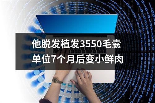 他脱发植发3550毛囊单位7个月后变小鲜肉