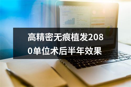 高精密无痕植发2080单位术后半年效果