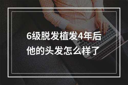 6级脱发植发4年后他的头发怎么样了