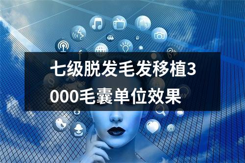 七级脱发毛发移植3000毛囊单位效果