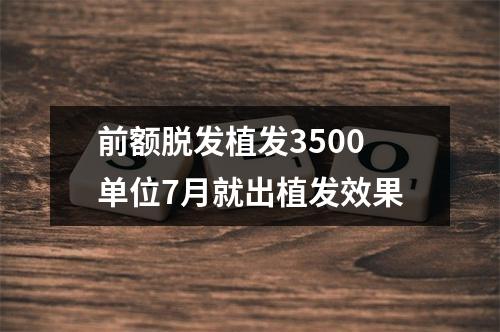 前额脱发植发3500单位7月就出植发效果