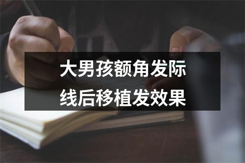 大男孩额角发际线后移植发效果