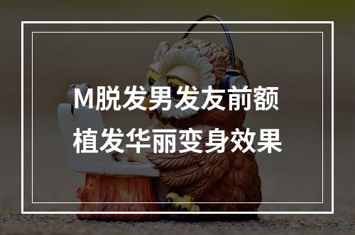 M脱发男发友前额植发华丽变身效果