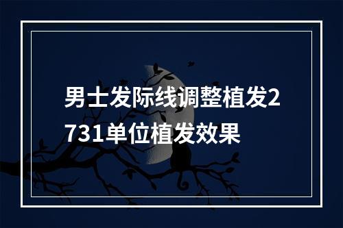 男士发际线调整植发2731单位植发效果