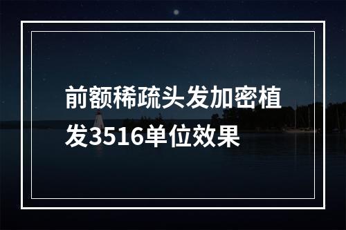 前额稀疏头发加密植发3516单位效果