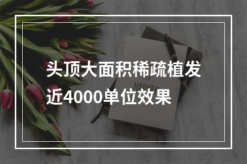 头顶大面积稀疏植发近4000单位效果