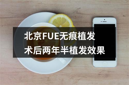 北京FUE无痕植发术后两年半植发效果