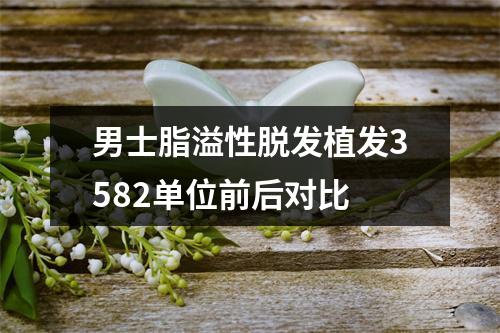 男士脂溢性脱发植发3582单位前后对比