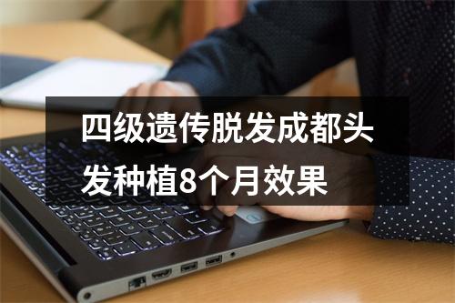 四级遗传脱发成都头发种植8个月效果