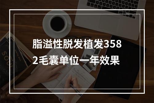 脂溢性脱发植发3582毛囊单位一年效果