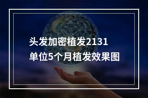 头发加密植发2131单位5个月植发效果图