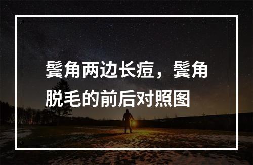 鬓角两边长痘，鬓角脱毛的前后对照图