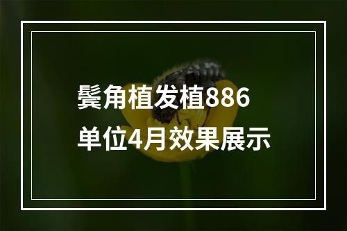 鬓角植发植886单位4月效果展示