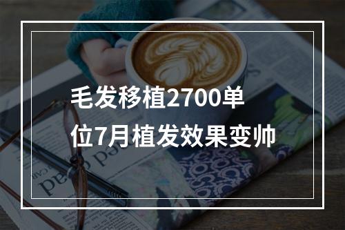 毛发移植2700单位7月植发效果变帅