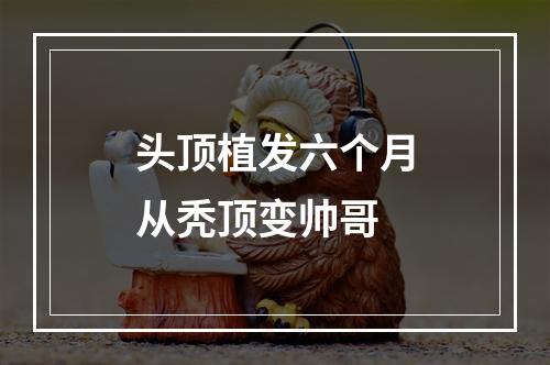 头顶植发六个月从秃顶变帅哥