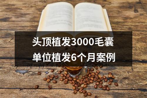 头顶植发3000毛囊单位植发6个月案例