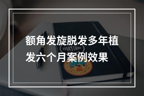 额角发旋脱发多年植发六个月案例效果