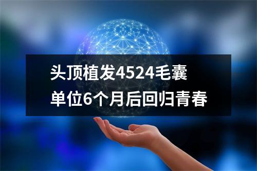 头顶植发4524毛囊单位6个月后回归青春