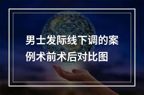 男士发际线下调的案例术前术后对比图