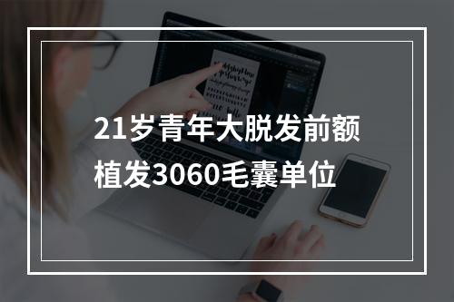 21岁青年大脱发前额植发3060毛囊单位