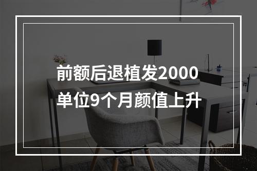 前额后退植发2000单位9个月颜值上升