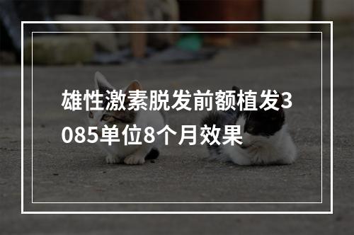 雄性激素脱发前额植发3085单位8个月效果