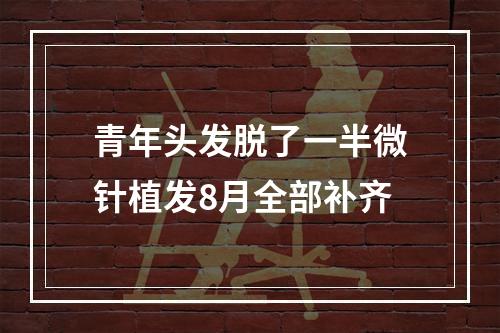 青年头发脱了一半微针植发8月全部补齐