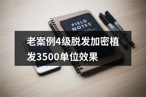 老案例4级脱发加密植发3500单位效果