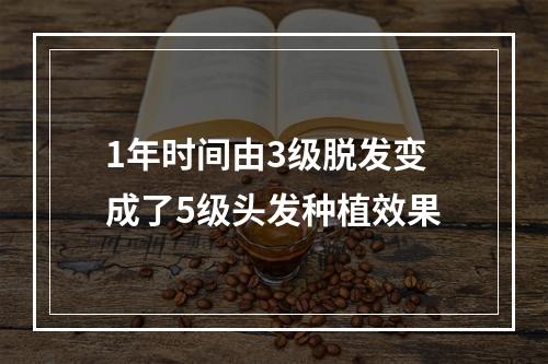 1年时间由3级脱发变成了5级头发种植效果