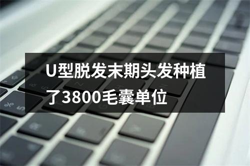 U型脱发末期头发种植了3800毛囊单位