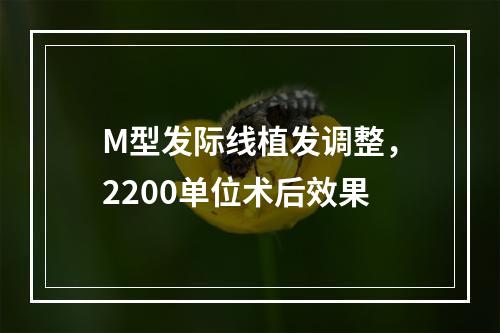 M型发际线植发调整，2200单位术后效果