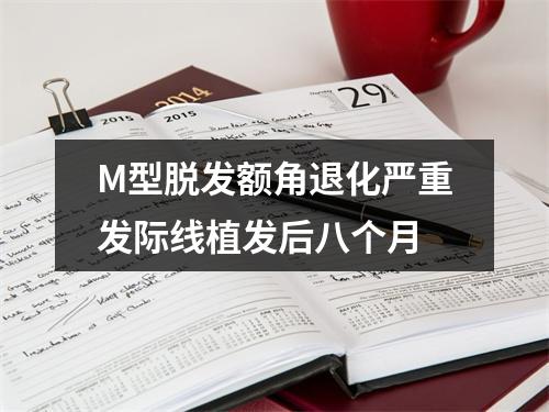 M型脱发额角退化严重发际线植发后八个月