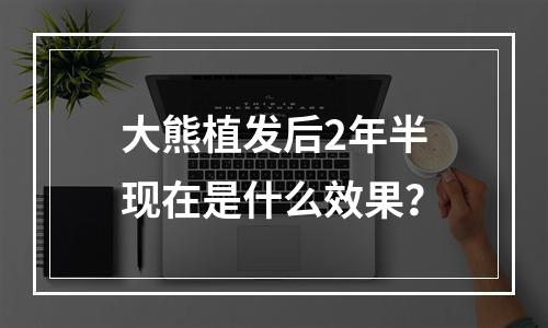 大熊植发后2年半现在是什么效果？