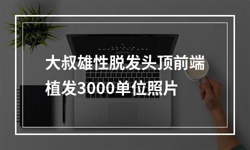 大叔雄性脱发头顶前端植发3000单位照片