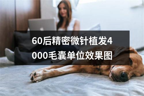 60后精密微针植发4000毛囊单位效果图