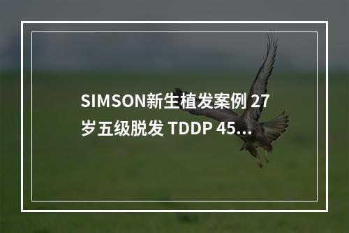 SIMSON新生植发案例 27岁五级脱发 TDDP 4500毛囊单位