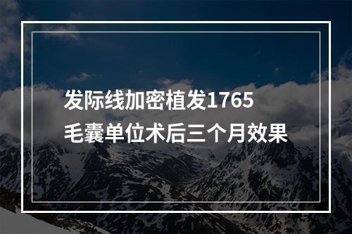 发际线加密植发1765毛囊单位术后三个月效果