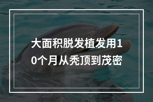 大面积脱发植发用10个月从秃顶到茂密