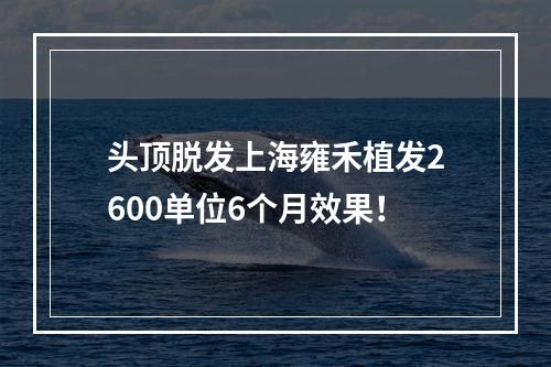 头顶脱发上海雍禾植发2600单位6个月效果！