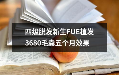 四级脱发新生FUE植发3680毛囊五个月效果