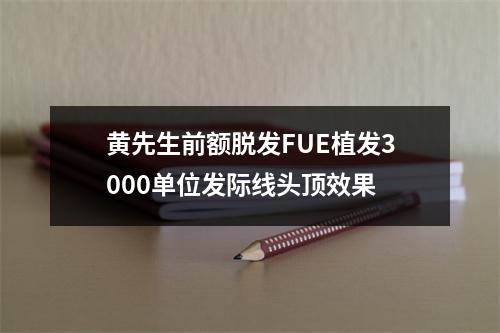 黄先生前额脱发FUE植发3000单位发际线头顶效果