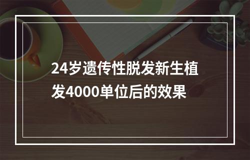 24岁遗传性脱发新生植发4000单位后的效果