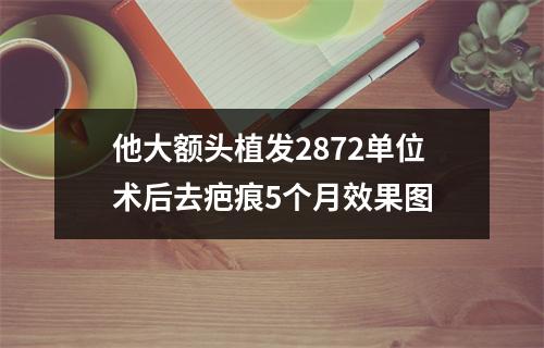 他大额头植发2872单位术后去疤痕5个月效果图