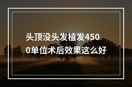 头顶没头发植发4500单位术后效果这么好