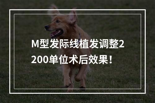 M型发际线植发调整2200单位术后效果！