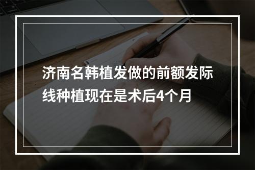 济南名韩植发做的前额发际线种植现在是术后4个月